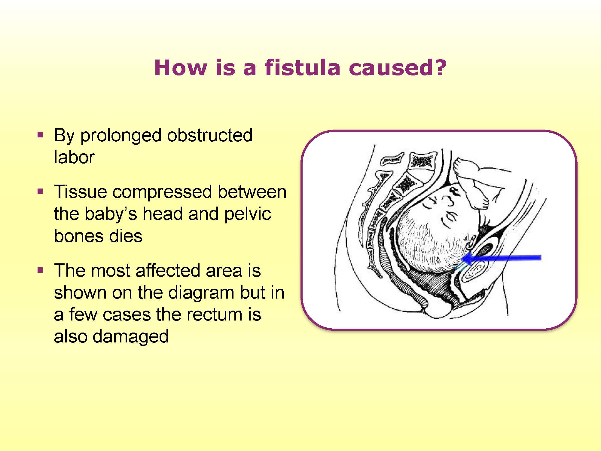 Obstetric Fistula Tutorial Glowm